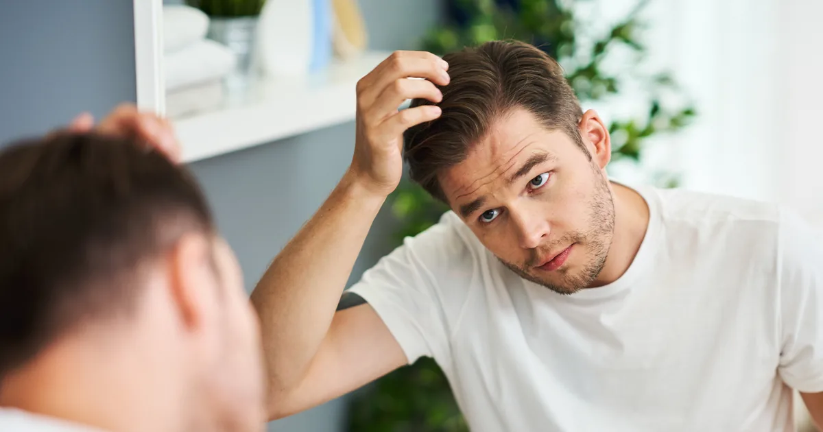 Signs of male hair loss and a receding hairline