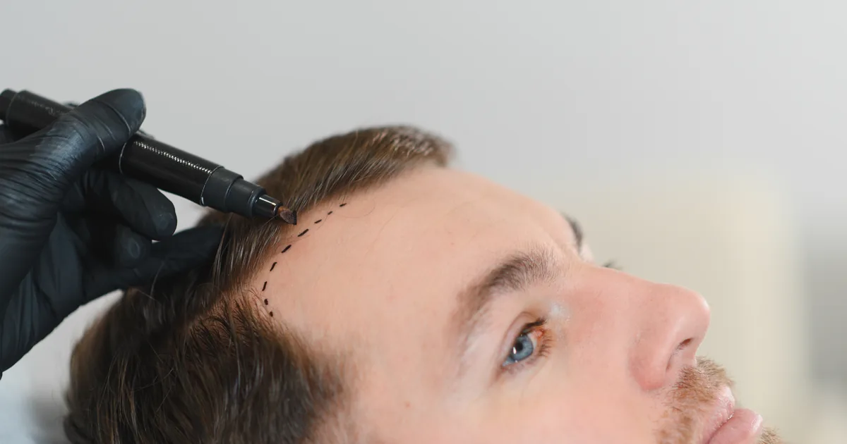 Graft count and donor area assessment in a hair transplant