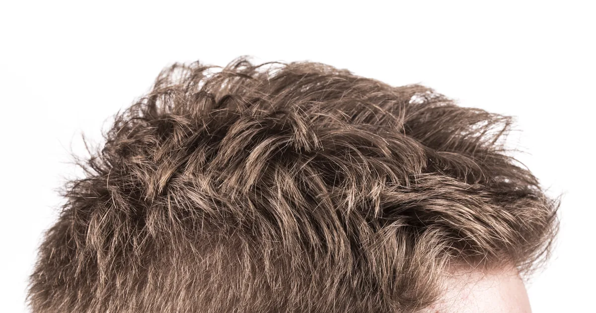 Assessing long-term hair density after a hair transplant