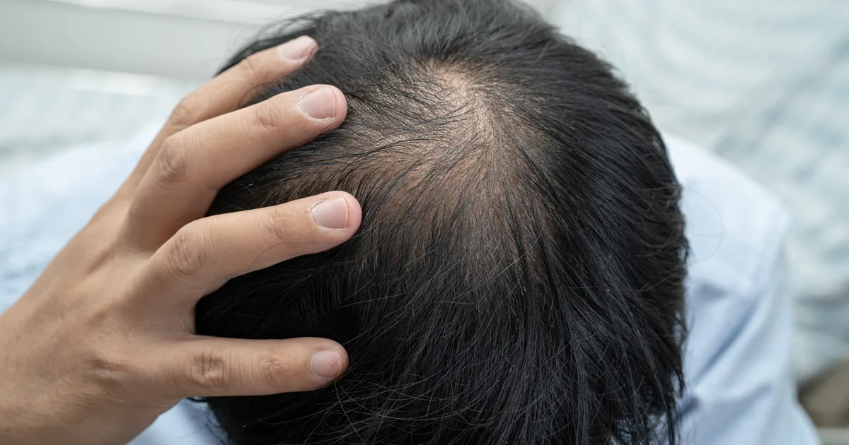 Temporary shock loss and new hair growth after a hair transplant