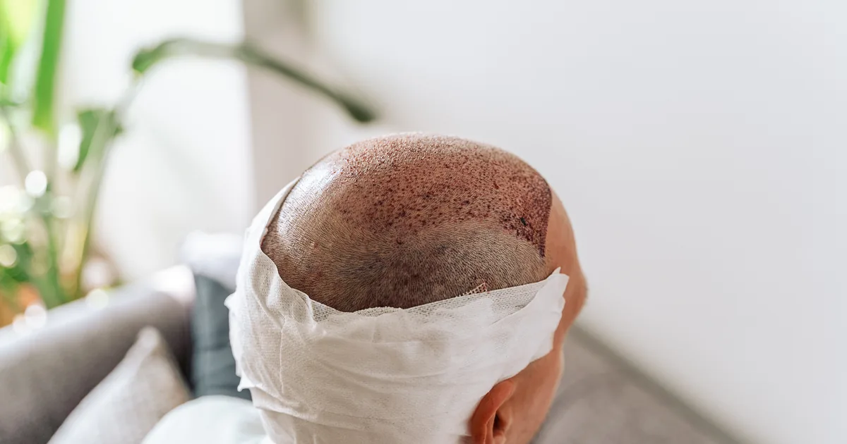 Hair transplant recovery and hair growth stages month by month
